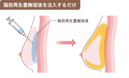 脂肪再生豊胸溶液を注入するだけ