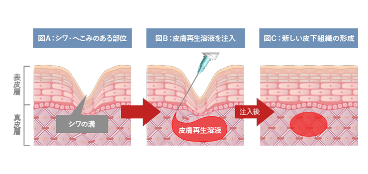 皮膚再生治療の流れ