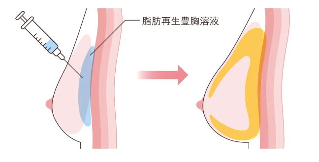 脂肪再生豊胸溶液を注入するだけ
